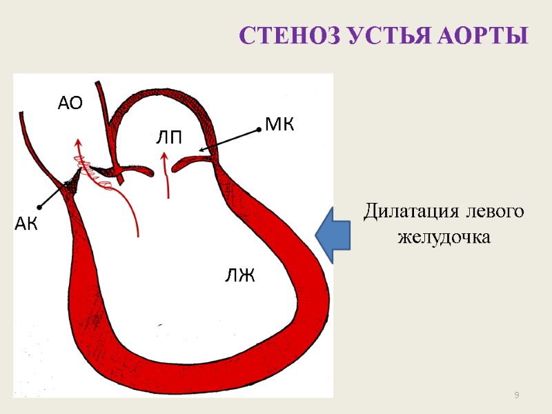 9 СТЕНОЗ УСТЬЯ АОРТЫ